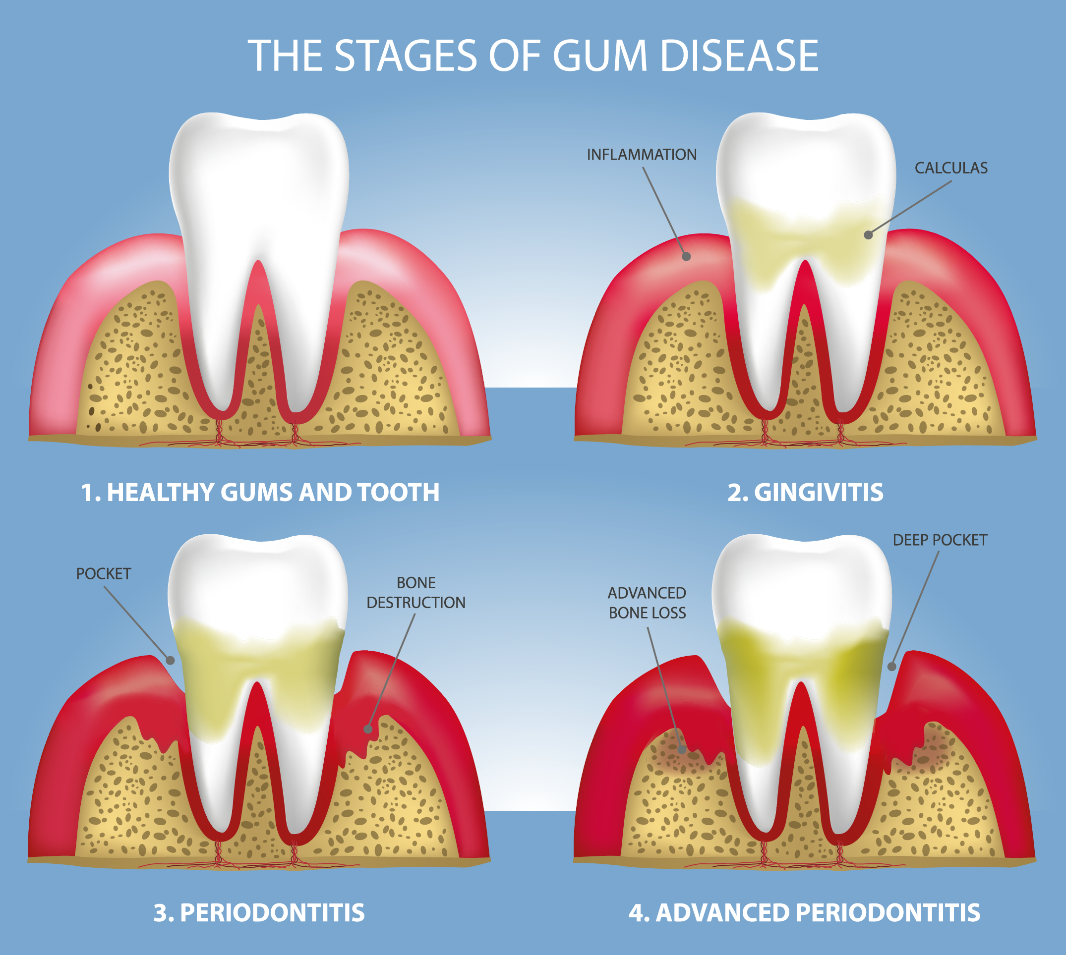 Gum Treatment Process